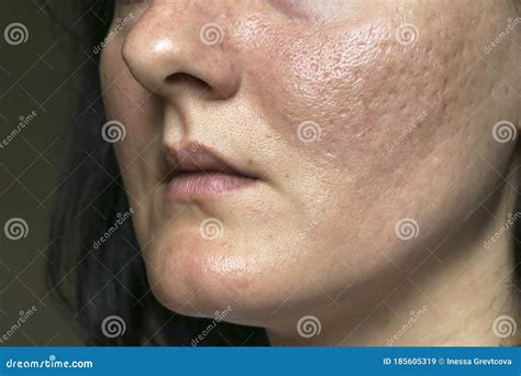 Woman With Problematic Skin And Acne Scars Pigmentation On Face Woman
