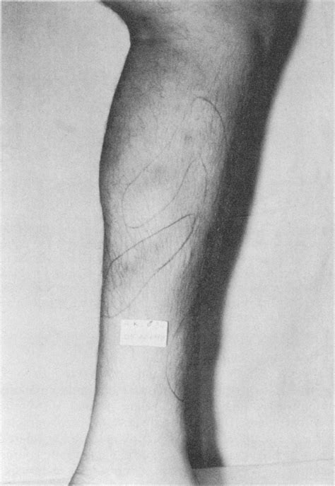 This Photograph Shows Superficial Migratory Thrombophlebitis In A