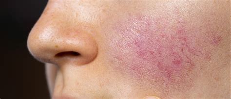 Rosacea What To Avoid And The Best Derm Approved Treatments Advanced