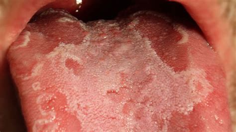 Bizarre condition makes tongue resemble a geographic map | Fox News