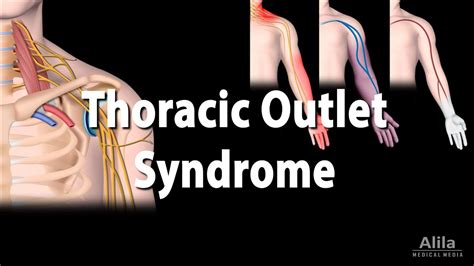 Thoracic Outlet Syndrome Tos Animation Youtube