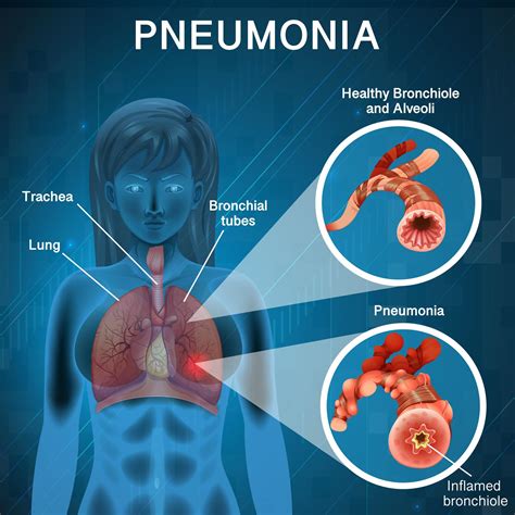 Pneumonia With Human Lungs Diagram Vector Art At Vecteezy