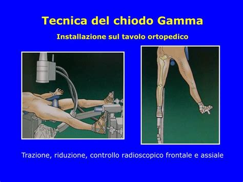 PPT - FRATTURE DEL COLLO PowerPoint Presentation - ID:1140827