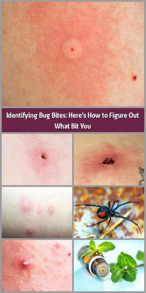 Bug Bites That Look Like Mosquito Bites But Aren T All Three Of These