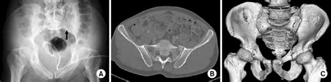 Pelvis Inlet Radiograph A Computed Tomography Ct Scan Axial Image