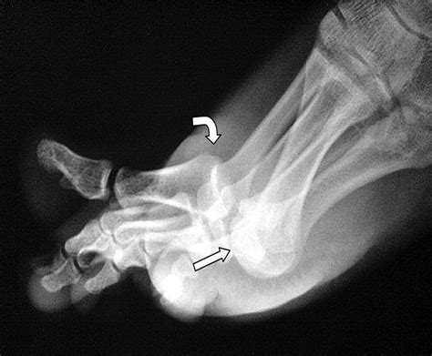 Traumatic Dislocation Of The First Metatarsophalangeal Joint With
