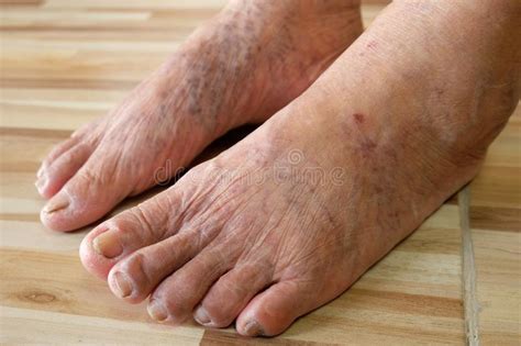 Close Up Varicose Veins On The Legs And Feet Stock Photo