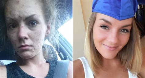 Flipboard Drug Addict Reveals Incredible Before And After Photos