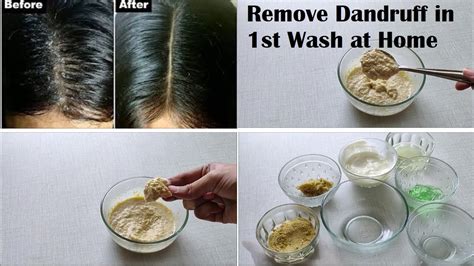 Best Remedy To Remove Dandruff Permanently And Naturally How To Get