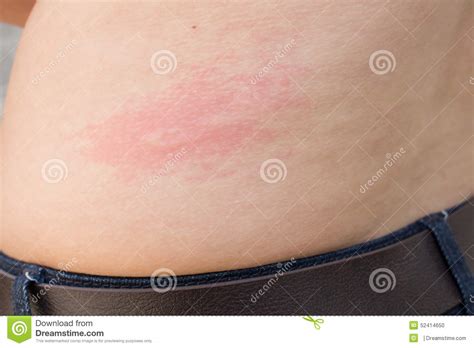 A Woman Is Urticaria On Back Stock Photo Image Of Lesions