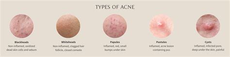 What Is Acne And Why Do I Have It Art Of Skin Care