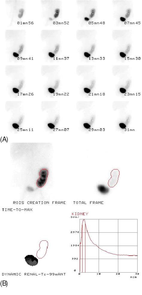 A And B 99mtc Dtpa Renal Scintigraphy Normal Functional Phase And