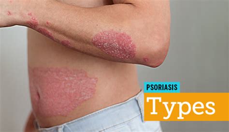 Pictures Of Psoriasis — Visual Guide For Types And Locations