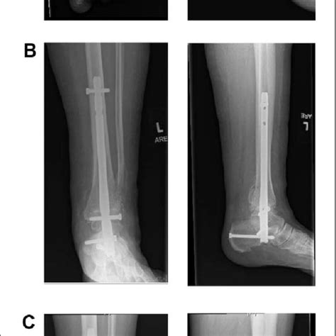 Pdf Primary Arthrodesis For Diabetic Ankle Fractures