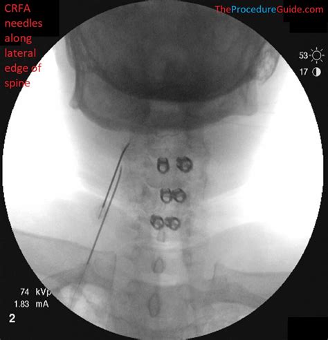Fluoroscopic Guided Lumbar Medial Branch Block Lmbb Technique And