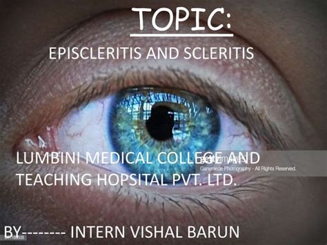 Episcleritis And Scleritis Ophthalmology Ppt