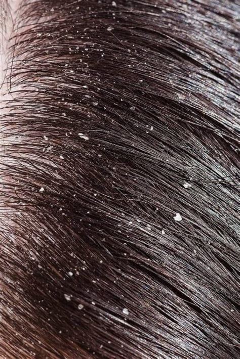 Keratin Treatment And Dandruff Whether There Is A Connection Between