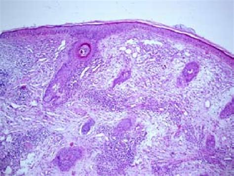Superficial Hyperkeratosis With Follicular Plugging Covered By An