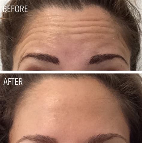 Botox Injections In Portland Maine Fantastic Results