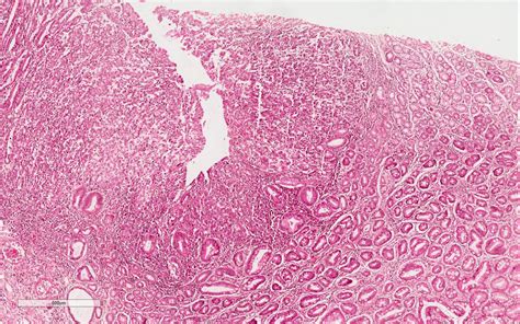 Pathology Outlines Early Gastric Carcinoma