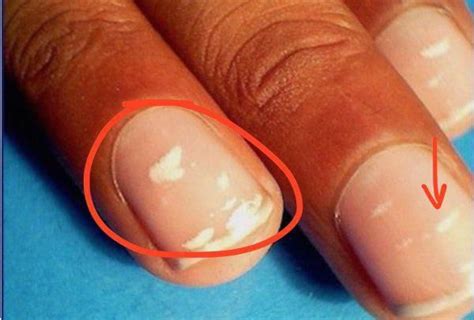 Its The Occurrence Of White Spots Or Patches Under The Nails Due To