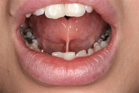 What Is A Frenectomy What Does “tongue Tied” Mean Miracle Mile Medical Group