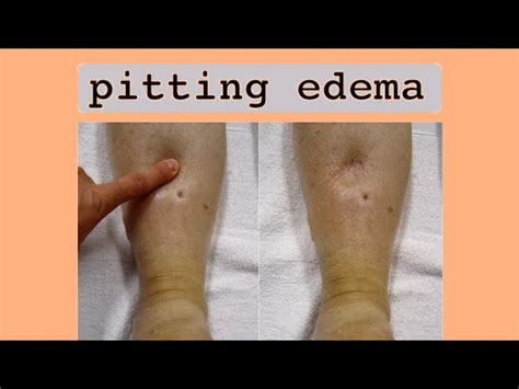 Pitting Edema Symptoms Causes And When To See A Docto