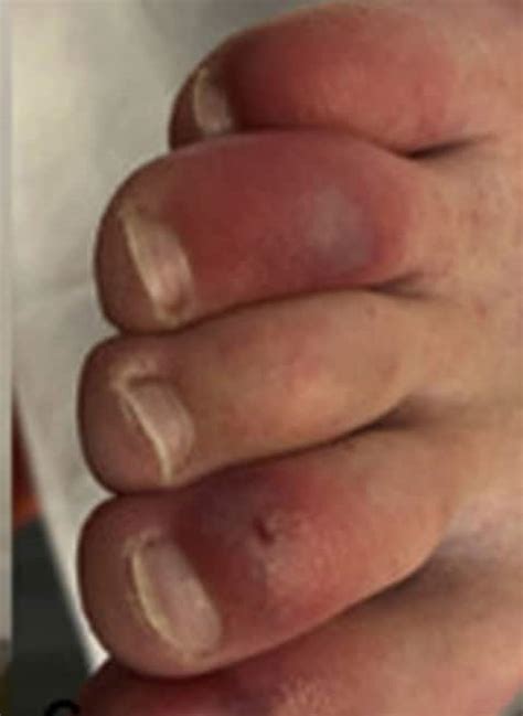 Covid Toes People Infected With Coronavirus May Develop Red And