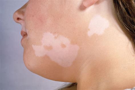 Vitiligo Tratamiento Tipos De Vitiligo Causas Y Remedios Naturales