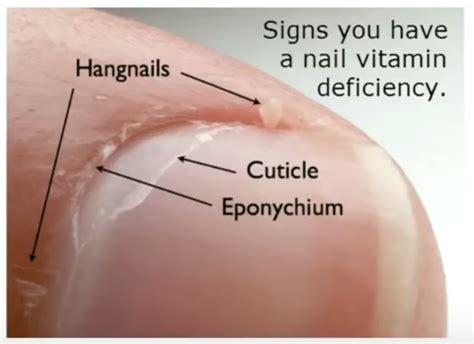 2018 Nails And Biotin Deficiency H Pylori Symptoms