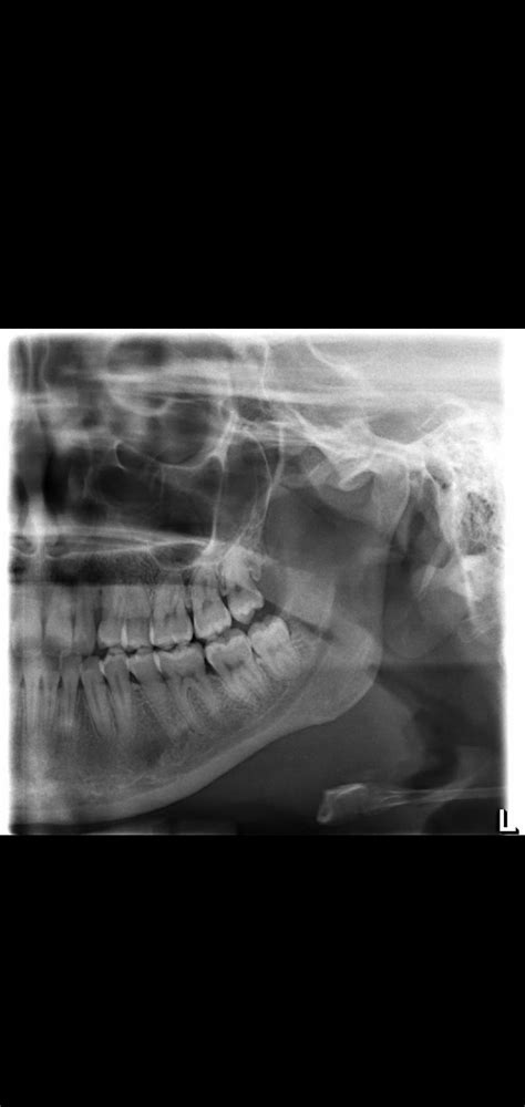 Partially Erupted Wisdom Tooth Would An Extraction Be Simple R