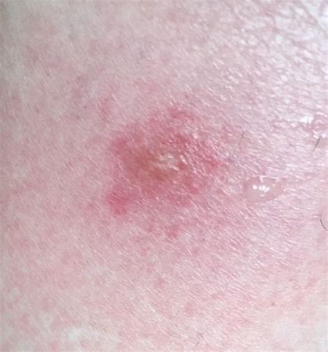 Maybe you would like to learn more about one of these? Spider bite 3 dot triangle, ONETTECHNOLOGIESINDIA.COM