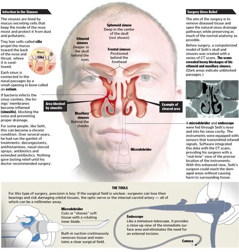 A Better Tomorrow Image Guided Sinus Surgery