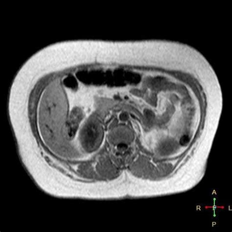 Horseshoe Kidney With Hypoplastic Left Lobe Radiology Case
