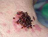 Images of Termite Bites