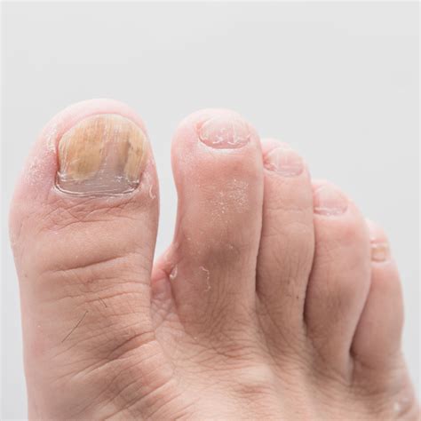 How To Know If Toenail Fungus Is Dying How To Know If Japanese