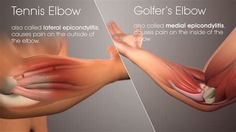 The tendons become inflamed where they join the bony part on the outside of your elbow joint. Common Golf Injuries - Golf Tip Review