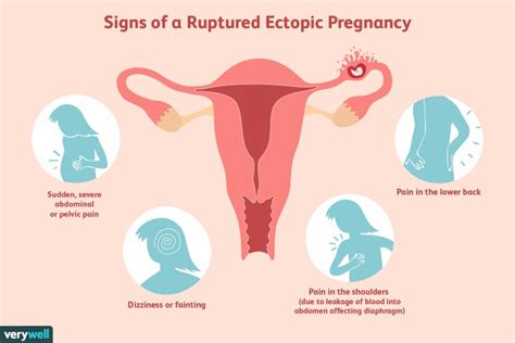 Ectopic Pregnancy Santripty Also Called A Tubal Pregnancy