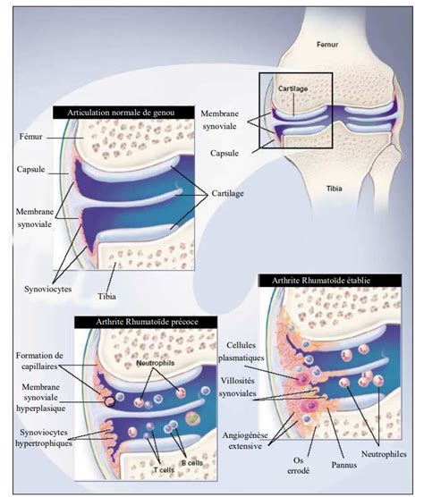 Comprende Larticulation Pathologique