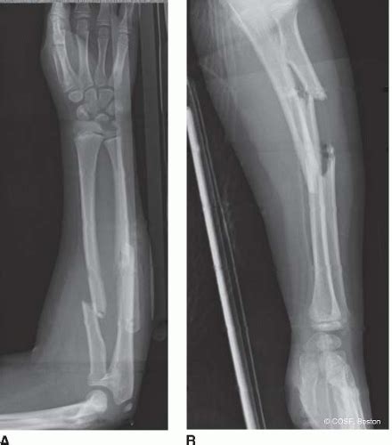 Forearm Fractures Musculoskeletal Key