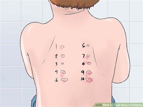 3 Ways To Treat Hives In Children Wikihow Mom
