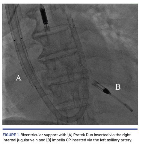 Percutaneous Biventricular Mechanical Circulatory Support With Impella