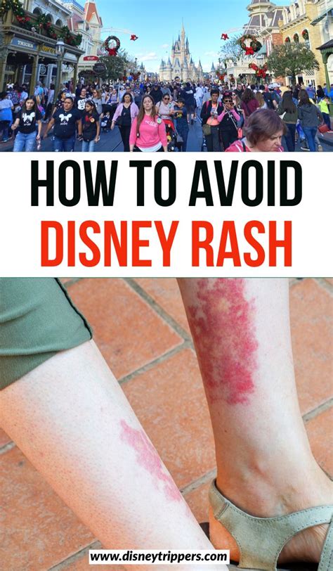 How To Avoid Disney Rash How To Treat And Prevent Disney Rash Tips