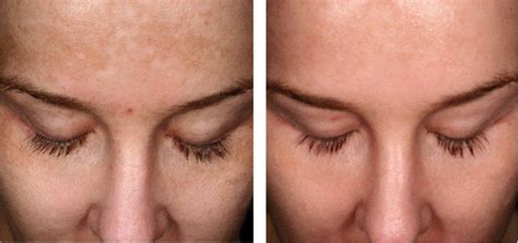 Our face is the first thing a person notices when we meet them, as most of us are used to talking to a person facing them and while looking at them. Skin Lightening / Whitening Treatment in Mumbai, India ...