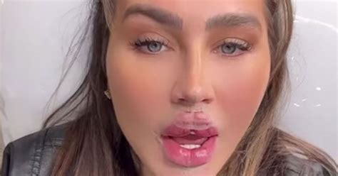 Lauren Goodger Joins Katie Price And Reveals New Butterfly Lips After