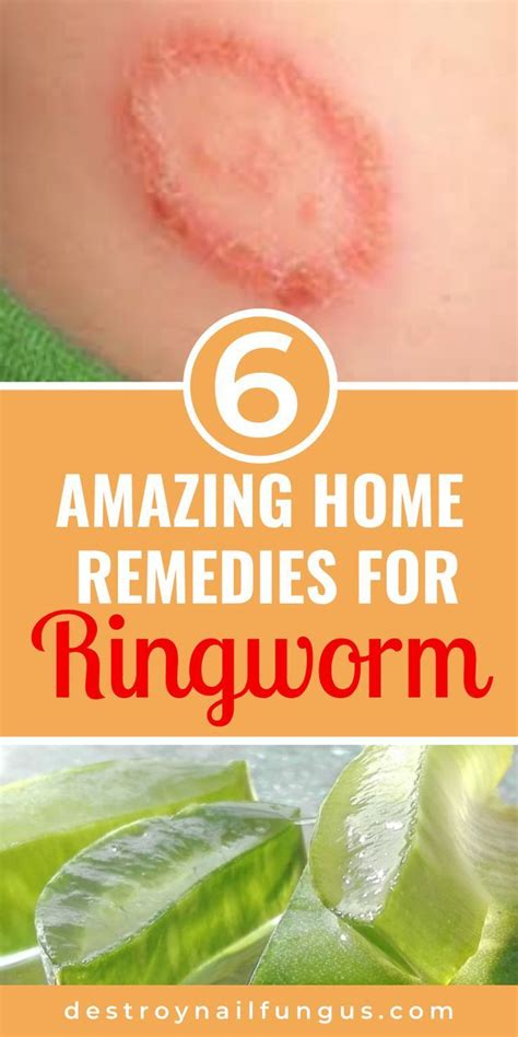 Ringworm Treatment For Humans