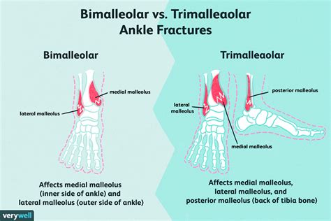 What Is The Posterior Lip Of Trimalleolar Fracture
