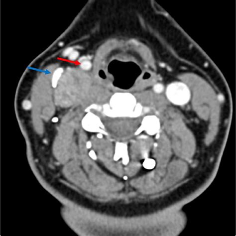 An Axial Ct Of The Neck Revealing An Oval Heterogeneous Mass In The