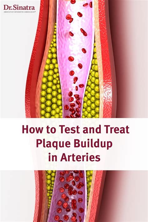 How To Test And Treat Plaque Buildup In Arteries Arteries Health Site Health And Fitness