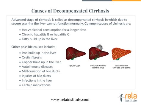 The liver is unable to perform its vital functions of many people think that only drinking excessive amounts of alcohol causes liver cirrhosis. Treatment of Decompensated Liver Disease | Best Liver ...